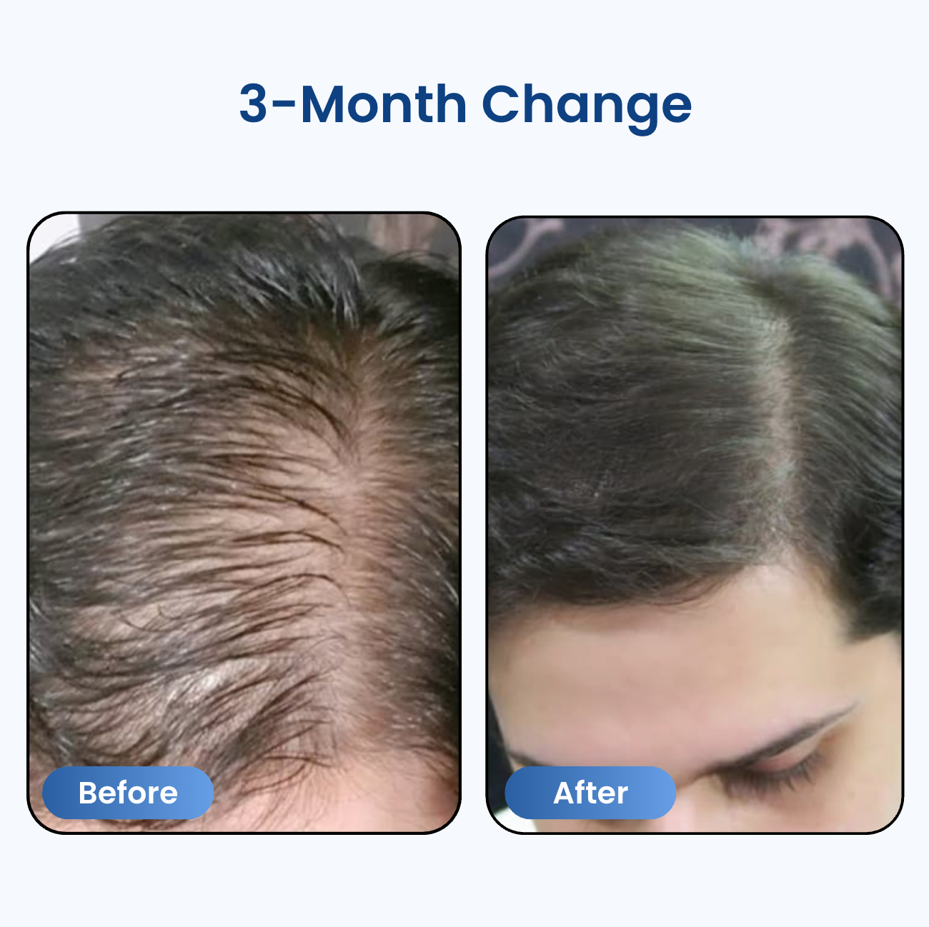 Precision Hair Recovery Roll-On®