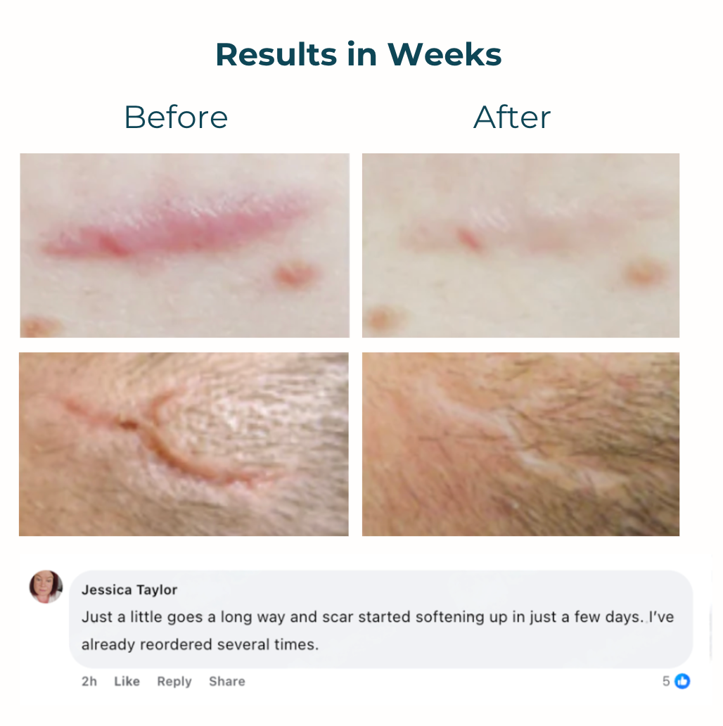 ScarMend | Surgeon-Grade Scar Repair Gel