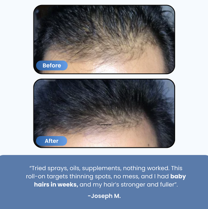 Precision Hair Recovery Roll-On®