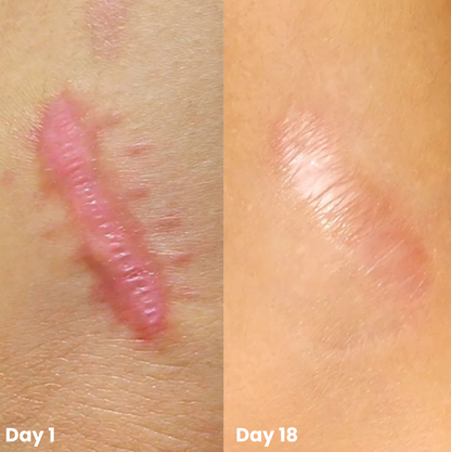 ScarMend | Surgeon-Grade Scar Repair Gel