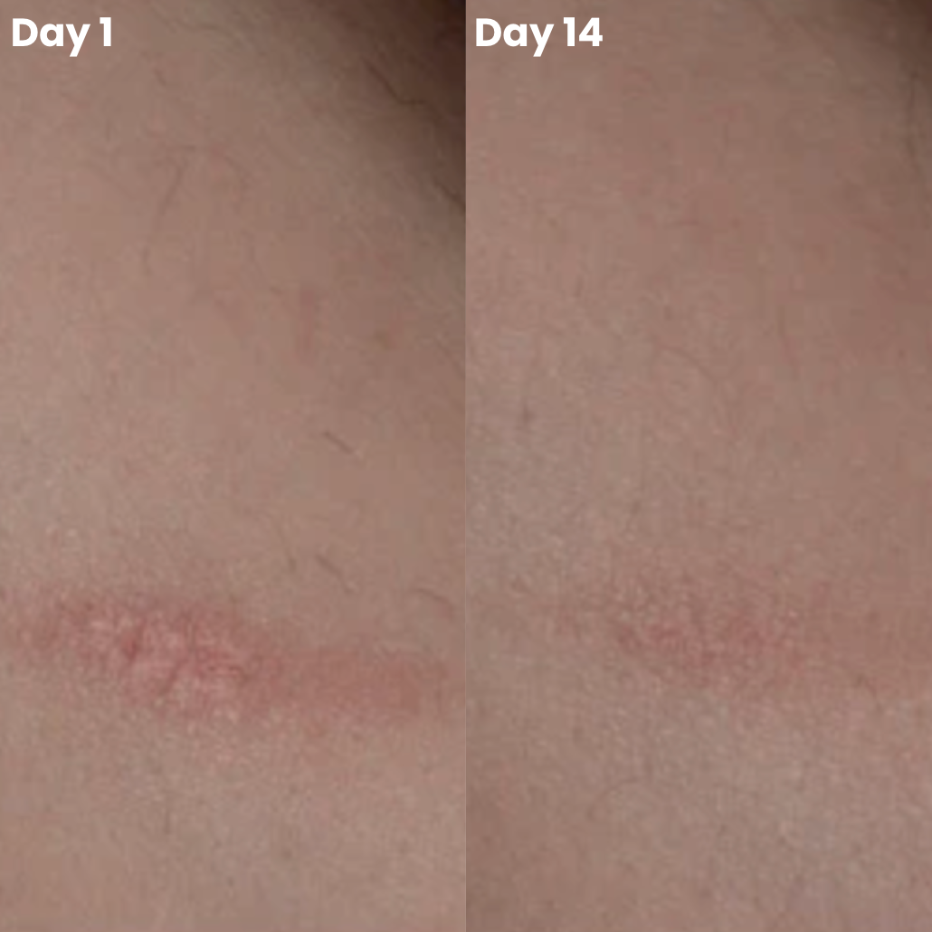 ScarMend | Surgeon-Grade Scar Repair Gel