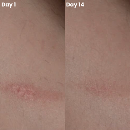 ScarMend | Surgeon-Grade Scar Repair Gel